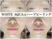 ホワイトアクア 梅田本店(WHITE AQUA)/ハーブピーリングで顎ニキビケア