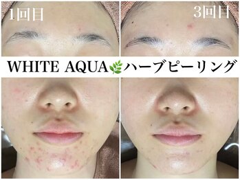 ホワイトアクア 梅田本店(WHITE AQUA)/ハーブピーリングで顎ニキビケア