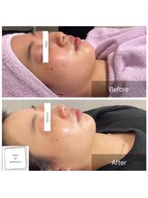 サロン ド パーフェクション(Salon de Perfection)/小顔リフト