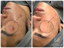ルクシア(RUXCIA)の雰囲気（毛穴が汚れているとスキンケアの効果も半減!!皮脂、顔ダニ除去）