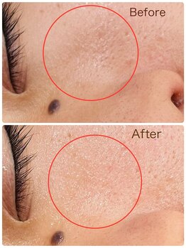 プチ プロムナード(Petit Promenade)/美肌フェイスWax