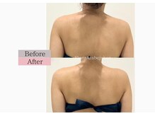 フロリール アザブジュウバン(FlorirAzabujuban)/痩身/盛り肩解消/天使の羽