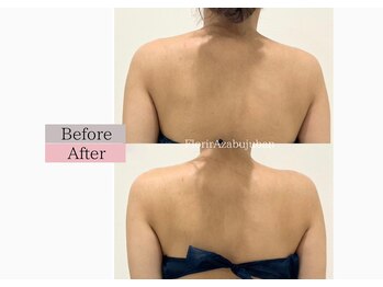 フロリール アザブジュウバン(FlorirAzabujuban)/痩身/盛り肩解消/天使の羽