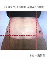 シュシュ(chouchou)/脂肪冷却 横腹