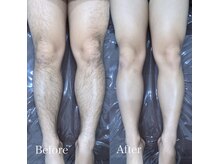 ハイリー(Hily)の雰囲気（#全身脱毛#メンズ脱毛#美肌脱毛#足）