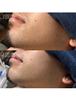 カナウ(KANAU)/ヒゲ脱毛（20代前半男性）