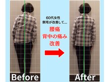 ソヴァール(SAUVEUR)/60代女性の側弯