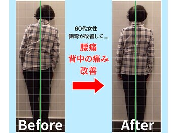ソヴァール(SAUVEUR)/60代女性の側弯