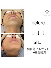 プライベートサロン コットン(COTTON)/ヒゲ脱毛