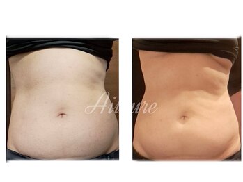 エルール トータルビューティ(Aileure total beauty)/脂肪燃焼ジェル