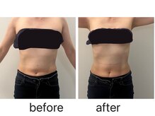 ナチュラル ユース(Natural youth)/お腹周りのbefore／after