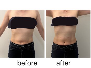 ナチュラル ユース(Natural youth)/お腹周りのbefore／after