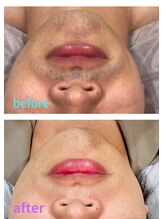 アースサロン(earth salon)/≪メンズ≫　ひげ脱毛