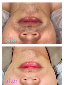 アースサロン(earth salon)/≪メンズ≫ ひげ脱毛