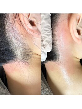 ルピナス(Lupinus)/うなじwax脱毛