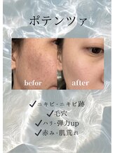 癒しの郷 池袋店/毛穴悩み/黒ずみ/乾燥肌/