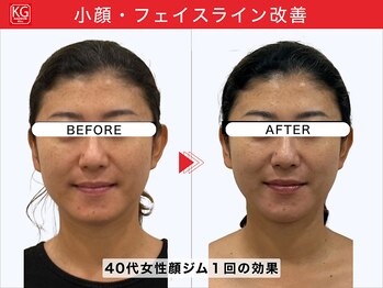 顔ジム 麻布店/40代女性 1回の小顔効果