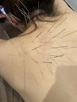 ロミハリ(LomiHari)/肩の鍼施術