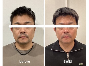 スリー治療院 伏見桃山(THREE治療院)/【メンズ・3ヵ月】小顔矯正