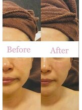 ブランシェ 金沢店 × 椿/シワ・たるみケア　お客様