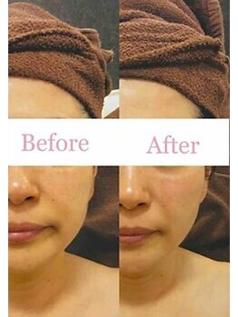 ブランシェ 金沢店 × 椿/シワ・たるみケア　お客様