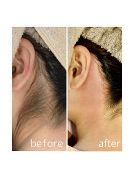 フリルスタイル(FRILL STYLE)/うなじ×もみあげ W脱毛