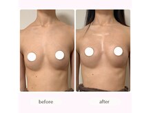 短期間＆都度払いで驚きのバストアップ☆