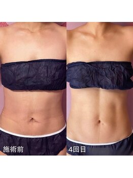 カウピリ(kaupili)/最新痩身マシン【スリムムーヴ】