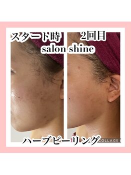 サロンシャイン(Salon Shine)/ハーブピーリング２回