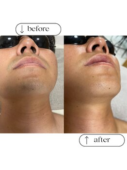 フルールスレーヌ(Fleur Sereine)/清潔感が一番☆本気の髭脱毛