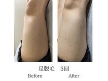 メンズミーシェ(Men's Meshie)/ひざ上脱毛施術前後