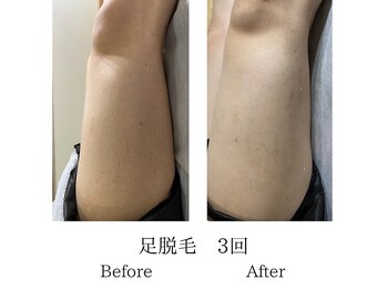 メンズミーシェ(Men's Meshie)/ひざ上脱毛施術前後