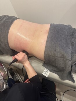 ビジリンヌ/ラジオ波フェイシャル