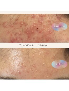トリートメントルーム フェリーチェ(Felice)/ニキビ・毛穴悩みに