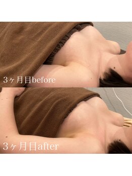 ビュエル(Beauel)/3ヶ月目before&after/6回目