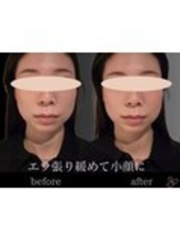 チョコバリ 錦糸町店(chocobari)/小顔×リフトアップ(美容鍼)20代