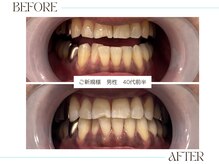 ホワイトニングサロンブライト 尼崎店(Whitening salon bright)/ホワイトニング5回目