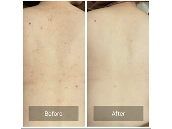 ビビ(VIVI)/背中のざらつきに◎