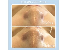 アイドット(EYE.)/ハイドロスプラッシュ毛穴洗浄