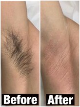 バブル(BUBRU)/脇脱毛