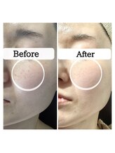 ル ボヌール/シミケア　3か月経過