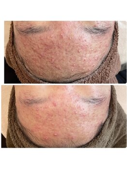 エン(O'en)/ハーブピーリング