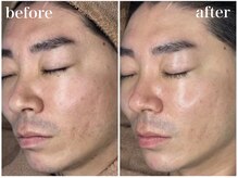 ホワイトアクア 錦糸町店(WHITE AQUA)/ララピール/毛穴/ニキビケア