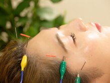 立川レディース鍼灸マッサージ はるはる/頭皮鍼で頭のモヤモヤ除去☆