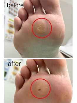 巻き爪補正店 姫路店/魚の目