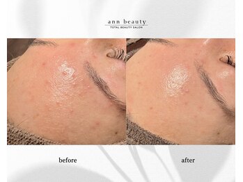 アン ビューティー(ann beauty)/【症例写真】20代