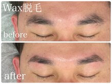 フルミー(fulme.)/WAX脱毛before＆after