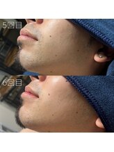 カナウ(KANAU)/ヒゲ脱毛（20代前半男性）