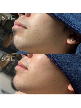 カナウ(KANAU)/ヒゲ脱毛（20代前半男性）