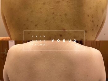 ボウ 名古屋店(VOEUX)の写真/何をしても変わらなかった繰り返すニキビに◎専門歴13年・23,000人の実績
